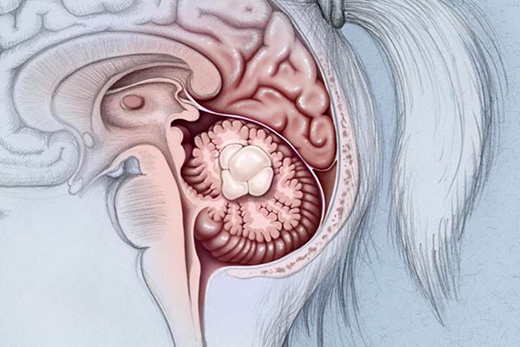 Medulloblastoma brain tumor in cerebellum of children