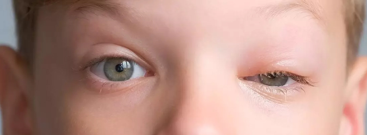 Rhabdomyosarcoma affecting soft tissue around eye in child
