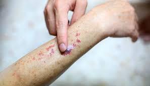 Early Signs of Blood Cancer You Should Never Ignore